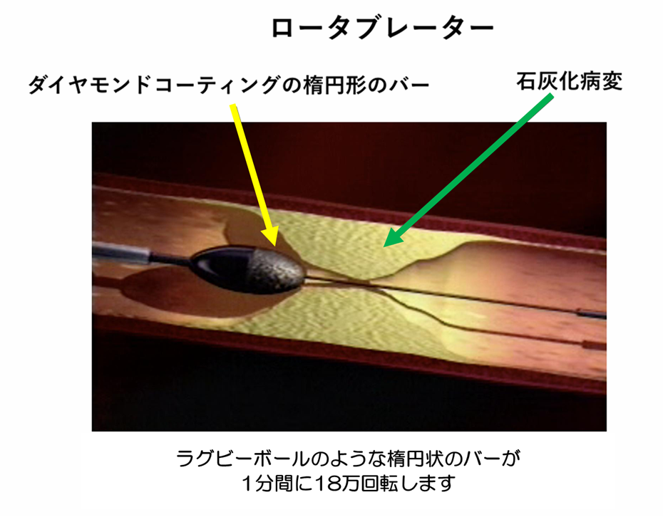 ロータブレーダー画像① ロータブレーダー画像①