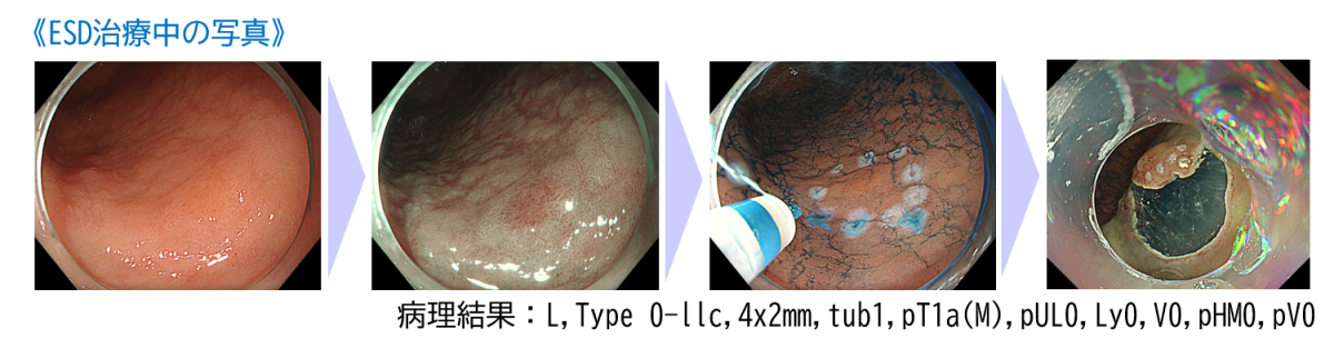ESD治療中の写真